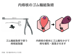 いぼ痔(痔核)の原因・症状・治療について【専門医が徹底解説】 - Amanex Blog